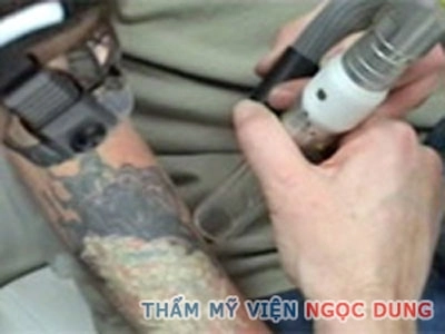 Tác dụng của laser trong việc xóa xăm - 1