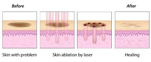 Tái tạo da theo phương pháp nội ứng - ngoại hợp - 2