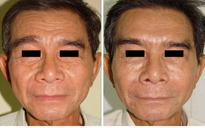 Trẻ hóa gương mặt bằng botox và restylane - 2