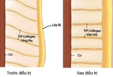 Trẻ hóa làn da nhờ sóng tạo năng lượng - 1