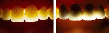 4 ưu điểm của răng sứ cercon - 1