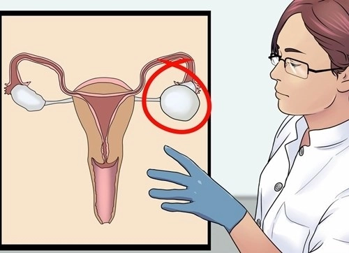 8 dấu hiệu đơn giản nhận diện u nang buồng trứng - 1