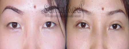 Bấm mí hàn quốc có ảnh hưởng đến thị lực của mắt - 1