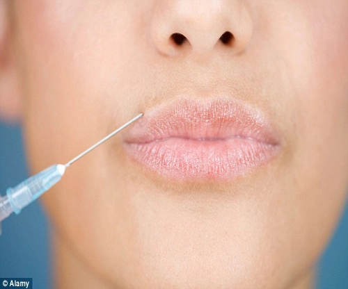 Biến dạng môi vì tiêm botox - 1