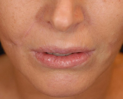 Biến dạng môi vì tiêm botox - 2