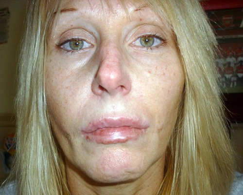 Biến dạng môi vì tiêm botox - 3