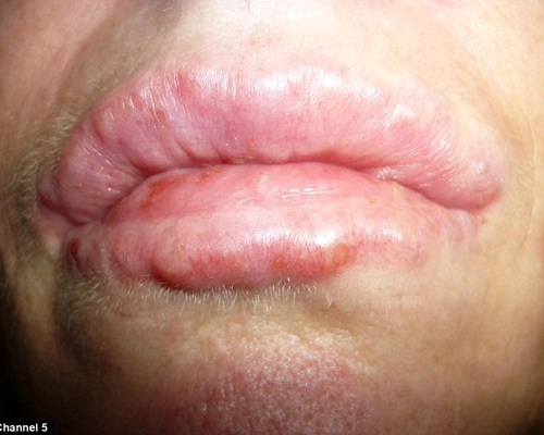 Biến dạng môi vì tiêm botox - 4
