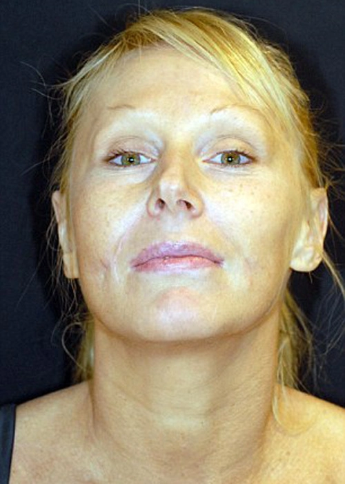 Biến dạng môi vì tiêm botox - 6