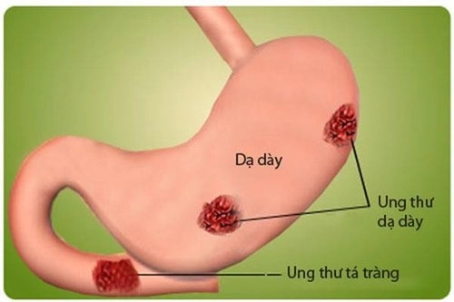 Các yếu tố nguy cơ và triệu chứng ban đầu của bệnh ung thư dạ dày - 1