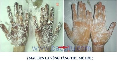 Chữa tăng tiết mồ hôi bằng botox - 1