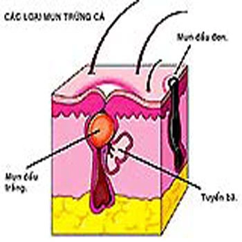 Điều trị và phòng ngừa mụn trứng cá hiệu quả - 1