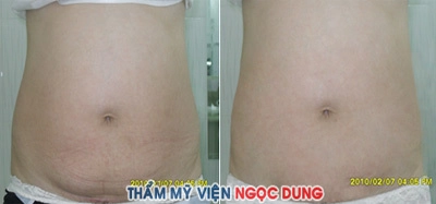 Hút mỡ bằng công nghệ coollipo cho nam và nữ - 1