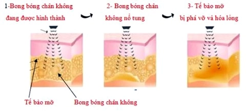 Ngấn mỡ nọng cằm - dấu hiệu của tuổi già - 2