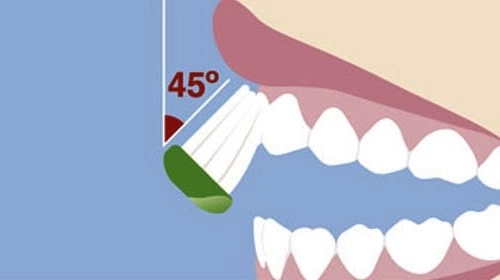 Phải làm sao khi đánh răng nhiều mà miệng vẫn hôi lợi vẫn viêm - 1