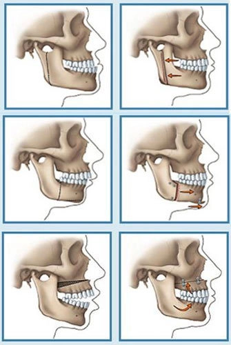 Phẫu thuật chỉnh hình răng hô - 1