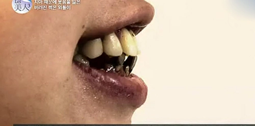 Pttm lung linh cho cô gái hỏng hàm răng - 3