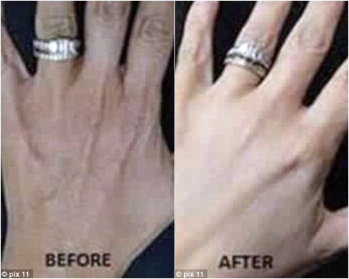 Rộ mốt phẫu thuật ngón tay đeo nhẫn cưới - 3