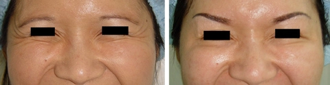 Trẻ hóa gương mặt bằng botox và restylane - 1