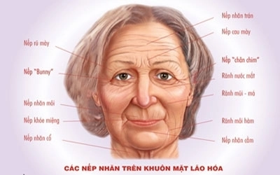 Trẻ lại nhờ botox và restylane - 1