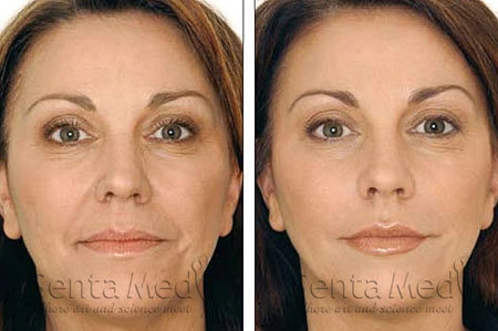 Xóa nhăn với retylane hay botox - 1