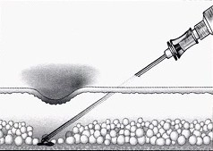 Xóa sẹo lõm làm đầy da vùng thân bằng macrolanetm - 1