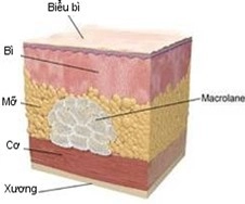 Xóa sẹo lõm làm đầy da vùng thân bằng macrolanetm - 2