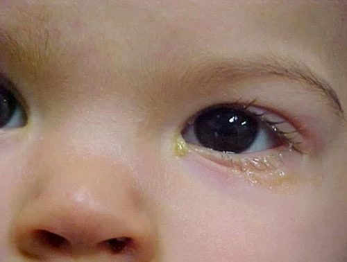 3 dấu hiệu nguy hiểm với mắt của bé - 1