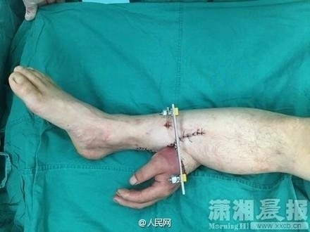 Bàn tay mọc ra từ chân và ca cấy ghép hi hữu - 1