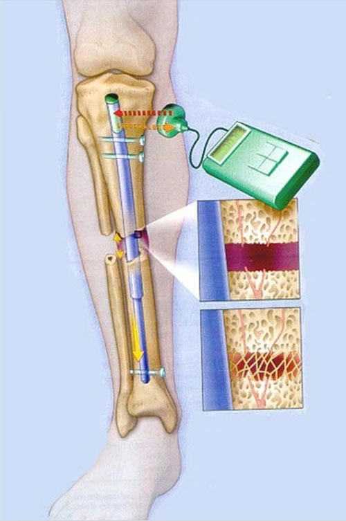 Bủn rủn với mốt phẫu thuật kéo dài chân - 3