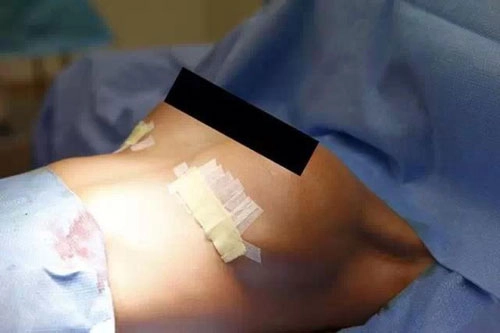 Cận cảnh quá trình một ca phẫu thuật nâng ngực - 3