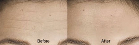 Chuyên gia tung chiêu giúp trẻ hóa không cần botox phẫu thuật - 5