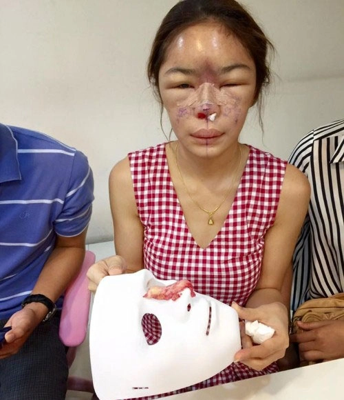 Cô gái suýt phải cắt bỏ mũi vì phẫu thuật thẩm mỹ hỏng - 1