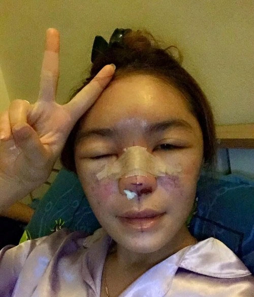 Cô gái suýt phải cắt bỏ mũi vì phẫu thuật thẩm mỹ hỏng - 2