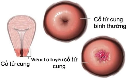 Mất cả chục triệu đồng vì viêm lộ tuyến cổ tử cung - 1