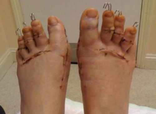 Mốt phẫu thuật chân để đi giày cao gót - 7