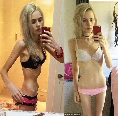 Cô gái 19 tuổi suýt chết vì nhịn ăn giảm cân - 1