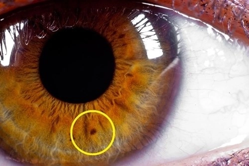 Đây là ý nghĩa của chấm đen trên mống mắt hãy kiểm tra ngay - 4