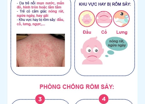 Infographics xử bay rôm sảy mùa hè cho bé - 2