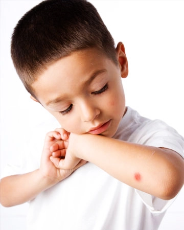 Trẻ bị muỗi đốt đã cósơn móng tay - 1