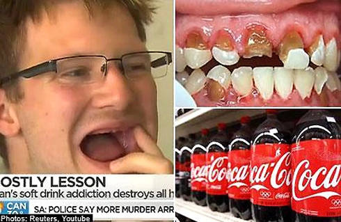  nghiện nước ngọt chàng trai 25 tuổi mất sạch răng - 1