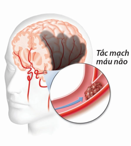  nguy cơ đột quỵ mất trí bởi gốc tự do - 1