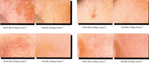  acnes c10 - giải pháp điều trị sẹo thâm - 3