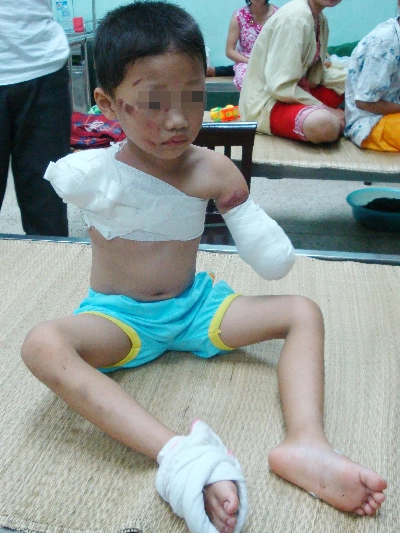  bé trai 5 tuổi bị gấu ăn mất hai cánh tay - 1
