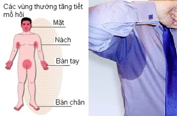  chữa tăng tiết mồ hôi và mùi cơ thể bằng sóng rf - 1