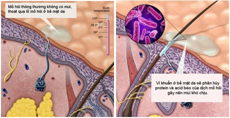  chữa tăng tiết mồ hôi và mùi cơ thể bằng sóng rf - 2