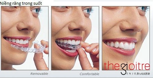 Công nghệ niềng răng trong suốt clevalign chính thức ra mắt ở việt nam - 3