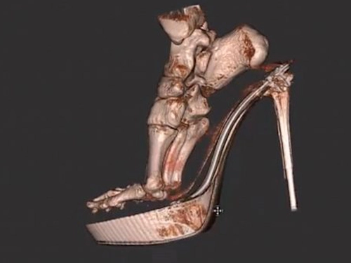  hình ảnh 3d bàn chân chấn thương do mang giày cao gót - 1