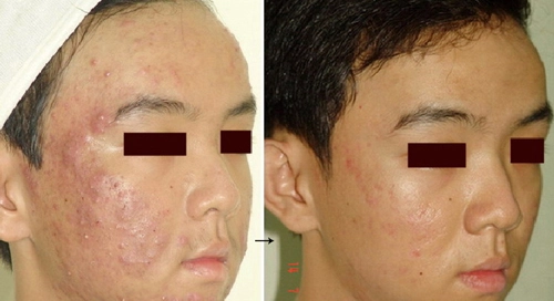  laser điều trị hiệu quả mụn và sẹo mụn - 2