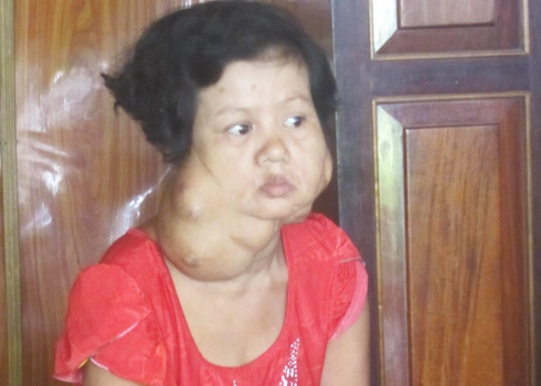 người phụ nữ 43 năm mang khối u quái trên mặt - 1