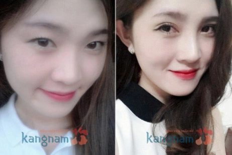 Quy trình biến hóa sắc đẹp korean beauty triangle ở kangnam - 4
